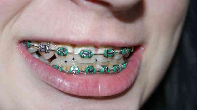 Braces