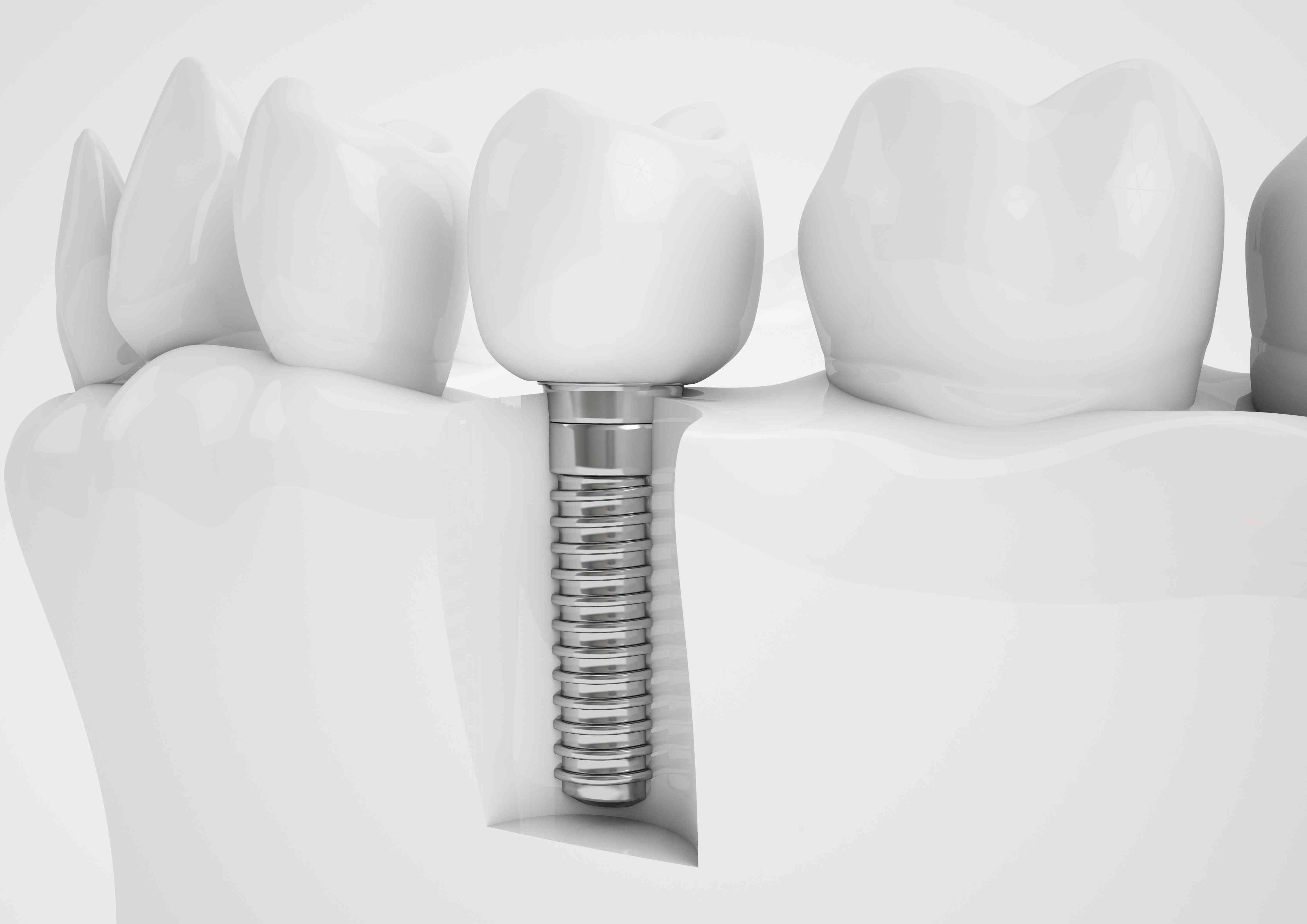 digital representation of dental implant