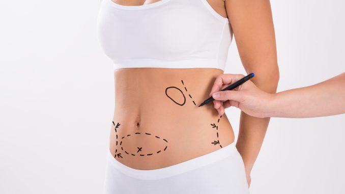 Doctor tracing the areas for liposuction