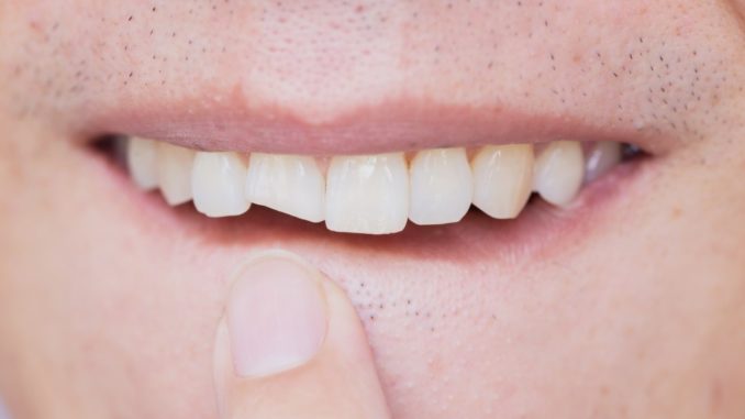 Man with cracked tooth