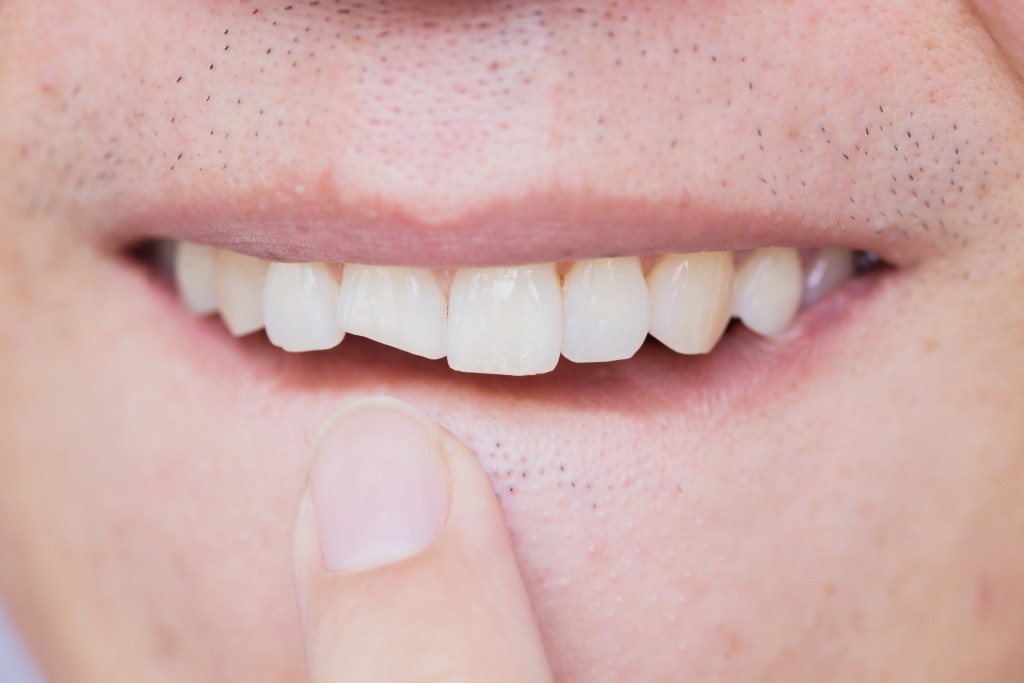 Man with cracked tooth